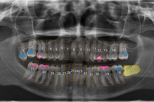 panoramic radiograph annotated