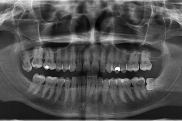 panoramic radiograph